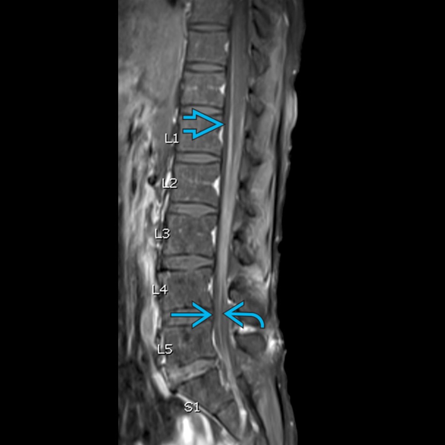 Sagittal T1 C+ FS MR of the lumbar spine in a patient with GBS shows CE nerve root enhancement, more intense in ventral  than dorsal  CE. Also note enhancement of the pial surface of the distal cord/conus . GBS is an immune-mediated peripheral nerves and nerve roots disorder, usually triggered by infections.
