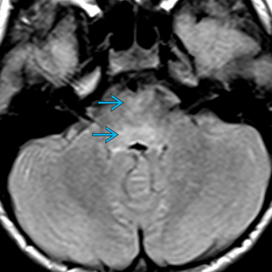 Axial FLAIR MR in a patient with Bickerstaff brainstem encephalitis (BBE) shows abnormal hyperintense signal in the pons  . Both MFS and BBE initially present with ophthalmoplegia, ataxia and areflexia; the differentiating feature being development of brainstem dysfunction in BBE later (reduced consciousness and pyramidal tract signs).