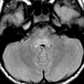 Axial FLAIR MR in a patient with Bickerstaff brainstem encephalitis (BBE) shows abnormal hyperintense signal in the pons  . Both MFS and BBE initially present with ophthalmoplegia, ataxia and areflexia; the differentiating feature being development of brainstem dysfunction in BBE later (reduced consciousness and pyramidal tract signs).