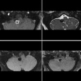 Dissecting pseudoaneurysm in the V4 segment of the right vertebral artery seen on 3D TOF MRA , T2 , and T1 pre-  and post  DANTE VWI sequences shows peripheral enhancement, suggestive of instability.