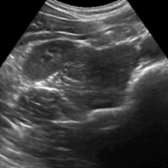 Transverse grayscale ultrasound of the right upper abdomen more inferiorly shows the relationship of the posterior abdominal wall muscles are maintained.