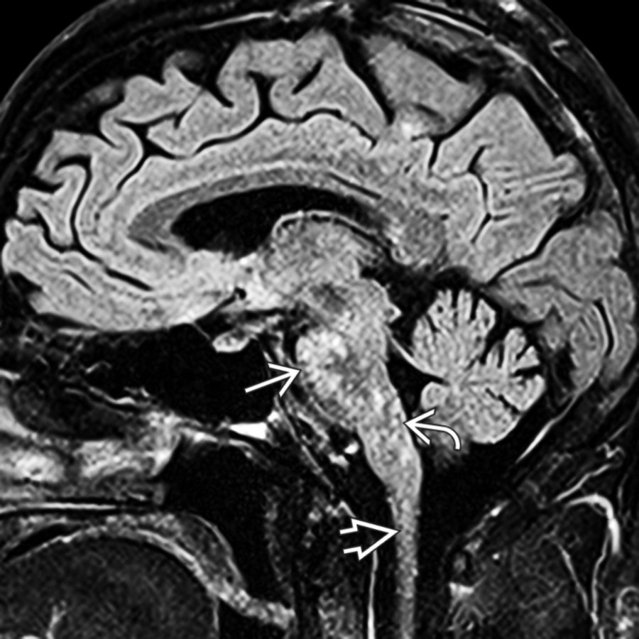 Sagittal FLAIR in the same patient obtained a year later when symptoms relapsed off steroids shows multiple punctate hyperintensities "peppering" the pons  and medulla . Note extension into upper spinal cord .