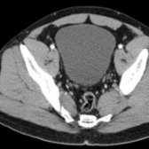 Axial correlative CECT shows the psoas and iliacus muscles have converged and are now indistinguishable from one another. The resultant iliopsoas muscle passes beneath the inguinal ligament and becomes tendinous as it inserts into the lesser trochanter of the femur.