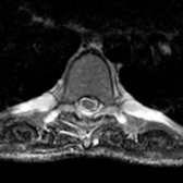 Axial T2WI MR shows diffuse thickening and hyperintensity of thoracic nerve roots and paraspinal intercostal nerves.