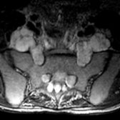 Axial T2WI MR shows marked enlargement of the lumbar/sacral nerve roots  and lumbosacral trunk .