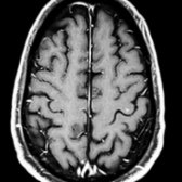 More cephalad T1 C+ FS MR in the same patient shows a solitary enhancing lesion  in the subcortical white matter of the "hand knob." One of the cerebellar lesions was biopsied and disclosed CD4+ T-cell perivascular infiltrates, consistent with CLIPPERS. In rare cases, CLIPPERS initially manifests as a more mass-like confluent pontine lesion before the typical peppering pattern emerges.