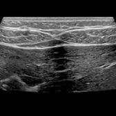 Transverse grayscale ultrasound of the abdominal wall at the midline shows the bilateral rectus abdominis muscles approximated by the linea alba. A portion of the left lobe of the liver and bowel is seen within the peritoneum.