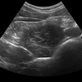 Transverse grayscale ultrasound in the lower abdominal region shows the right psoas muscle, composed of the psoas minor which rests upon the psoas major. The 2 muscles cannot be separated clearly on ultrasound. Because of their depth, the paraspinal muscles cannot be demonstrated in detail.