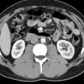 Axial correlative CECT of the paraspinal muscles at the level of the kidneys shows that the erector spinae muscles originate from a broad and thick tendon, which originates from the sacrum and iliac crest, lumbar, and 11th and 12th thoracic spinous processes.