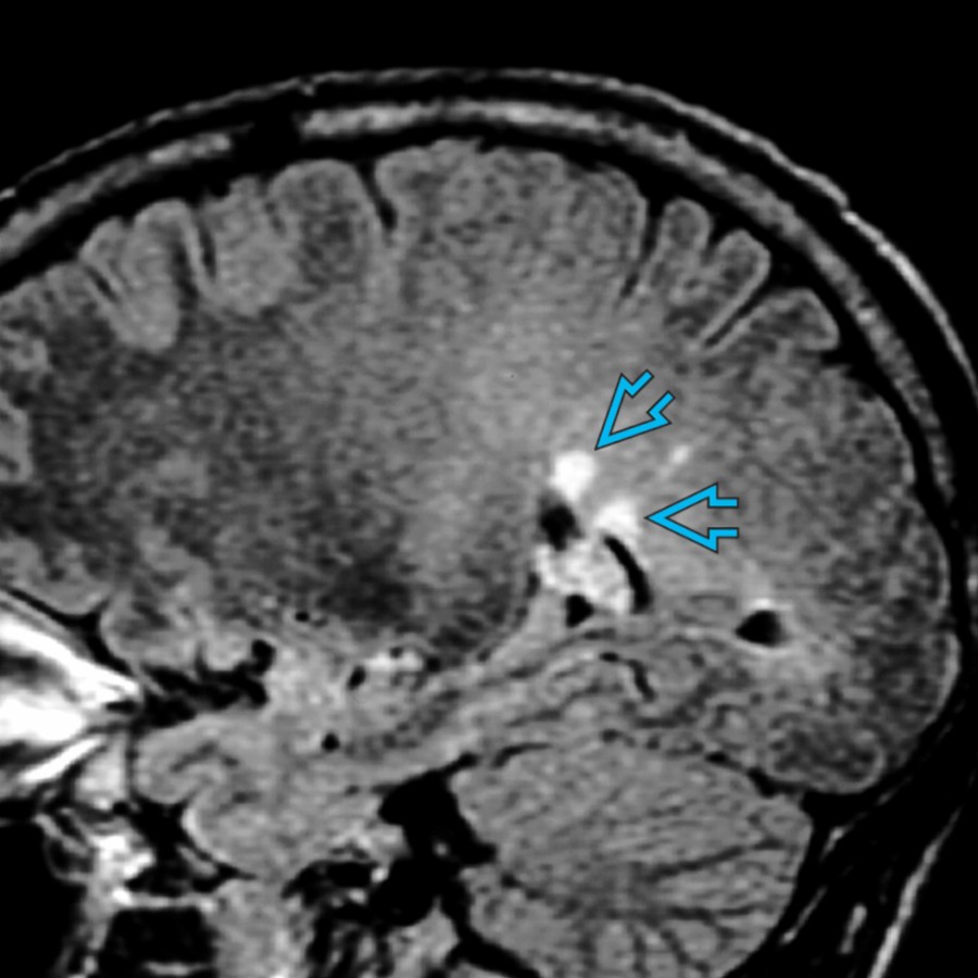 Sagittal FLAIR MR demonstrates periventricular ovoid hyperintensities  in a typical case of marked fusiform CIDP nerve enlargement with brain demyelination.