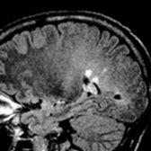 Sagittal FLAIR MR demonstrates periventricular ovoid hyperintensities  in a typical case of marked fusiform CIDP nerve enlargement with brain demyelination.