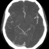 Axial MIP from CT arteriography shows fusiform dilatation of the left middle cerebral artery bifurcation  in this child with a history of Marfan syndrome.