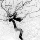 Lateral angiography in 30-year-old man with a subarachnoid hemorrhage shows an elongated, bizarre-appearing, multilobulated aneurysm  with long aspect ratio, tit-like projections.