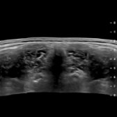 Transverse extended FOV grayscale ultrasound of the back (with patient prone) shows the erector spinae muscles flanking the spinous process. They are invested by lumbodorsal fascia, which also invests the anteriorly located quadratus lumborum muscle. The kidneys are partially demonstrated.