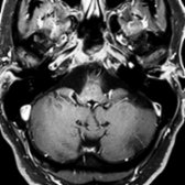 More inferior T1 C+ FS MR in the same patient shows additional small enhancing foci in the medulla .
