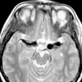 Axial T2WI MR shows strikingly enlarged middle cerebral arteries  in this child with congenital HIV/AIDS (an uncommon but well-recognized cause of pediatric fusiform arteriopathy). The stroke-like presentations of HIV infection may relate to vasculopathies, including large-vessel aneurysmal vasculopathy.