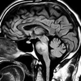 Sagittal FLAIR in a 52-year-old man with diplopia, dysarthria, and facial numbness shows confluent hyperintensity in the pons .
