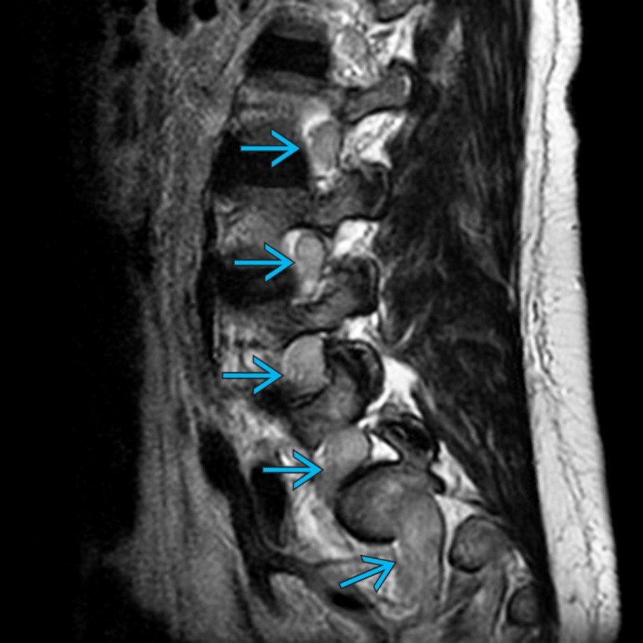 Sagittal T2WI MR reveals enlargement and T2 hyperintensity of exiting extradural lumbosacral nerves . High signal of CSF should be excluded while measuring nerve root size/area in T2 MR.