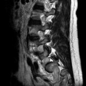Sagittal T2WI MR reveals enlargement and T2 hyperintensity of exiting extradural lumbosacral nerves . High signal of CSF should be excluded while measuring nerve root size/area in T2 MR.