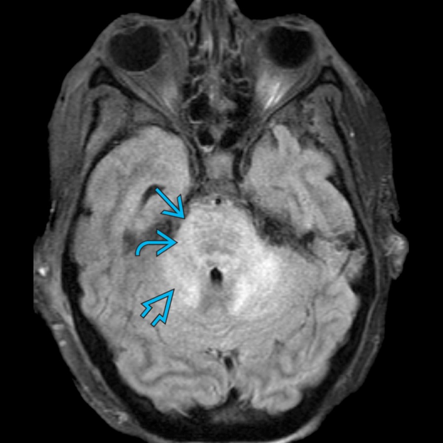 Axial FLAIR MR in a patient with BBE shows hyperintense signal in the pons , middle cerebellar peduncles , and cerebellum . Both MFS and BBE may initially show ophthalmoplegia, ataxia, and areflexia, the differentiating feature being reduced consciousness and other brainstem signs in BBE later.