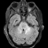 Axial FLAIR MR in a patient with BBE shows hyperintense signal in the pons , middle cerebellar peduncles , and cerebellum . Both MFS and BBE may initially show ophthalmoplegia, ataxia, and areflexia, the differentiating feature being reduced consciousness and other brainstem signs in BBE later.
