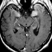 Axial T1 C+ MR shows enhancement in the medial temporal lobes and left anterior temporal lobe related to limbic encephalitis. As imaging mimics herpes encephalitis, most patients are initially treated with antiviral therapy until HSV titers are found to be negative.