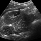 Transverse grayscale ultrasound of right midabdomen using the kidney as an acoustic window is shown. The kidney is anterior and lateral to the psoas and anterior to the quadratus lumborum. The psoas runs along the paravertebral region in its entire abdominal course. The quadratus lumborum originates from the iliolumbar ligament and iliac crest to insert into the last rib and lumbar transverse processes. It is easily identified as the muscle on which the kidney rests.