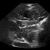 Transverse oblique grayscale ultrasound of the left erector spinae muscle (with patient prone) is shown. The 3 columns (iliocostalis, longissimus, and spinalis muscles, from lateral to medial) comprising the erector spinae are not clearly separated from one another on ultrasound. They are identified collectively as a thick, fleshy muscle lateral to the spinous process.
