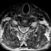 Axial T2WI MR reveals bilateral symmetric enlargement, hyperintensity of cervical nerve roots and brachial plexus .