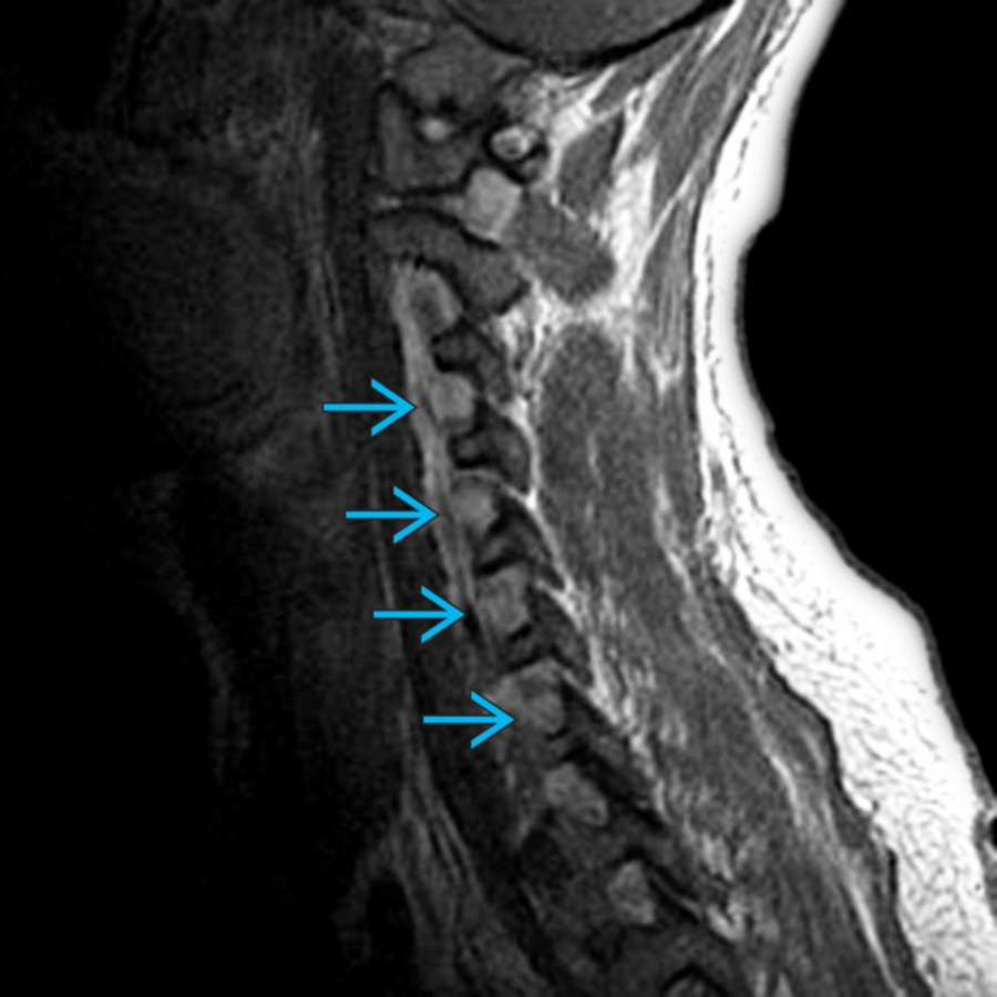 Sagittal T1 C+ MR of the cervical spine shows marked hypertrophy and enhancement of all exiting cervical nerve roots . 5 mm is considered an adequate cut-off value of cervical spinal nerve root diameter, discriminating CIDP from controls. Mean diameter of spinal nerve roots in CIDP: Cervical 6-6.8 mm; lumbosacral 7.3-10.4 mm.