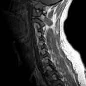 Sagittal T1 C+ MR of the cervical spine shows marked hypertrophy and enhancement of all exiting cervical nerve roots . 5 mm is considered an adequate cut-off value of cervical spinal nerve root diameter, discriminating CIDP from controls. Mean diameter of spinal nerve roots in CIDP: Cervical 6-6.8 mm; lumbosacral 7.3-10.4 mm.