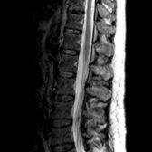 Sagittal T2WI MR demonstrates diffuse thickening of the intradural cauda equina nerve roots.