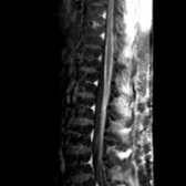 Sagittal T1WI C+ MR demonstrates diffuse pial thickening and enhancement extending into the cauda equina nerve roots. Clinical course distinguished from Guillain-Barré (AIDP).
