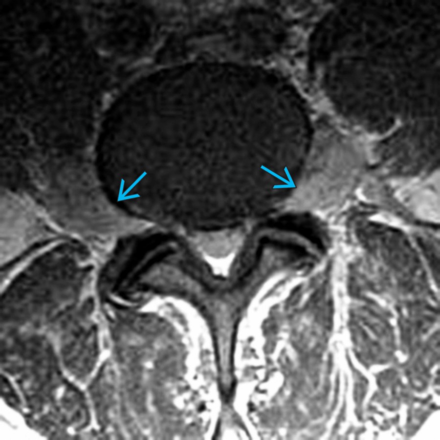 Axial T1WI C+ MR depicts enlargement and abnormal enhancement of exiting extradural lumbosacral nerves . Blood-nerve barrier breakdown can cause contrast enhancement. Axon loss associated with demyelination is the most important factor of disability and resistance to treatment. Root hypertrophy also may cause stenosis symptoms.