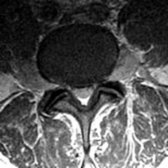 Axial T1WI C+ MR depicts enlargement and abnormal enhancement of exiting extradural lumbosacral nerves . Blood-nerve barrier breakdown can cause contrast enhancement. Axon loss associated with demyelination is the most important factor of disability and resistance to treatment. Root hypertrophy also may cause stenosis symptoms.