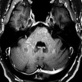 Axial T1 C + FS MR in the same patient shows small, punctate foci of enhancement  "peppering" the pons, cerebellar peduncles.