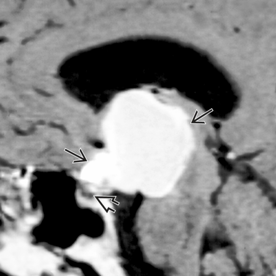 Sagittal T1 MR shows large, hyperintense craniopharyngioma originating from the 3rd ventricle  and hypothalamus. Note sparing of the suprasellar cistern .