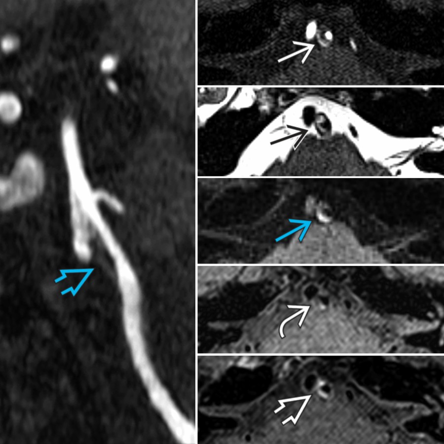 3D TOF MPR  and axial TOF  show ~ 50% narrowing of the left V4 vertebral artery. T2 SPACE shows a lipid/necrotic core . MPRAGE is positive for IPH . DANTE T1 SPACE pre-  and post-  contrast images demonstrate avid wall enhancement (active plaque).