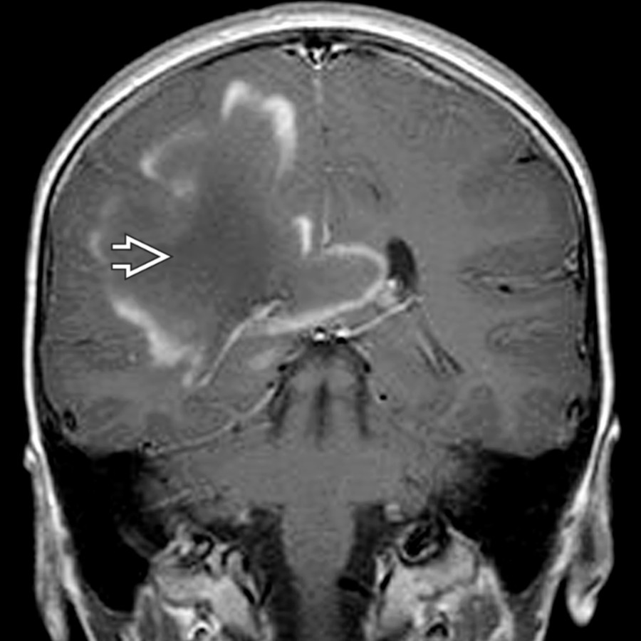 Coronal T1 C+ MR in the same patient  reveals an incomplete ring of enhancement surrounding the mildly hypointense lesion , permitting a diagnosis of tumefactive MS.