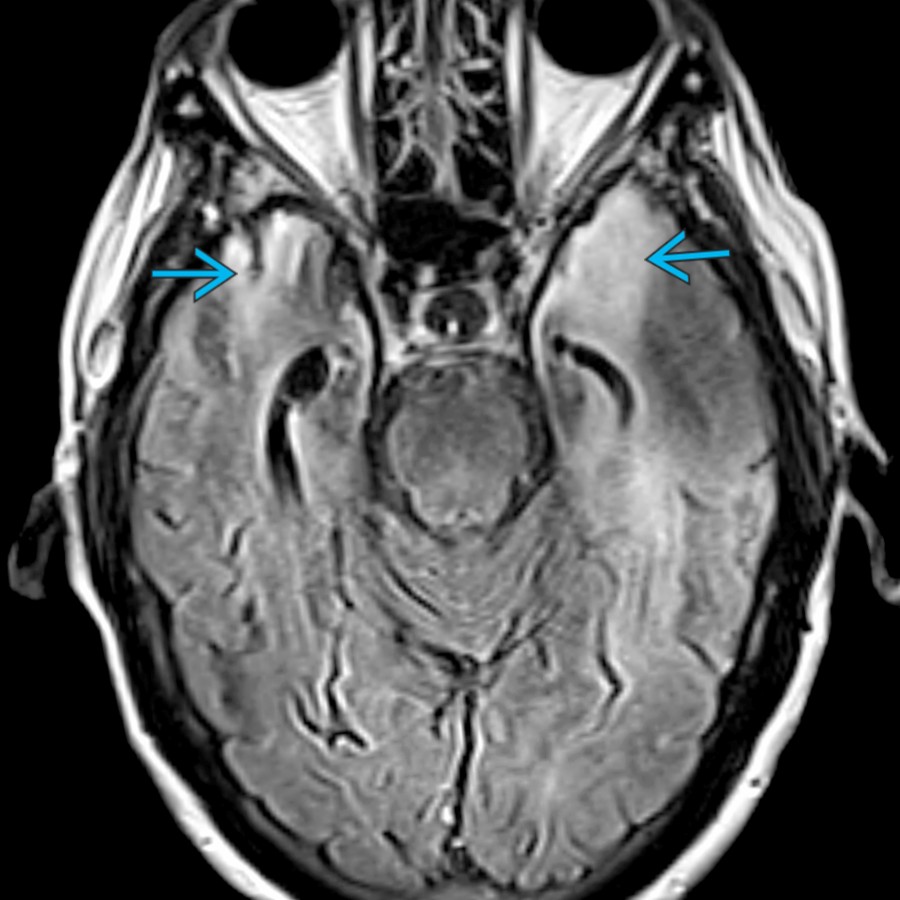 Axial FLAIR MR in this patient with ovarian cancer shows T2 hyperintensity of the temporal lobes , consistent with autoimmune, paraneoplastic, limbic encephalitis. Compared to herpes encephalitis, autoimmune encephalitis is more likely to be bilateral, symmetric without decreased diffusion. The basal ganglia are more commonly involved.