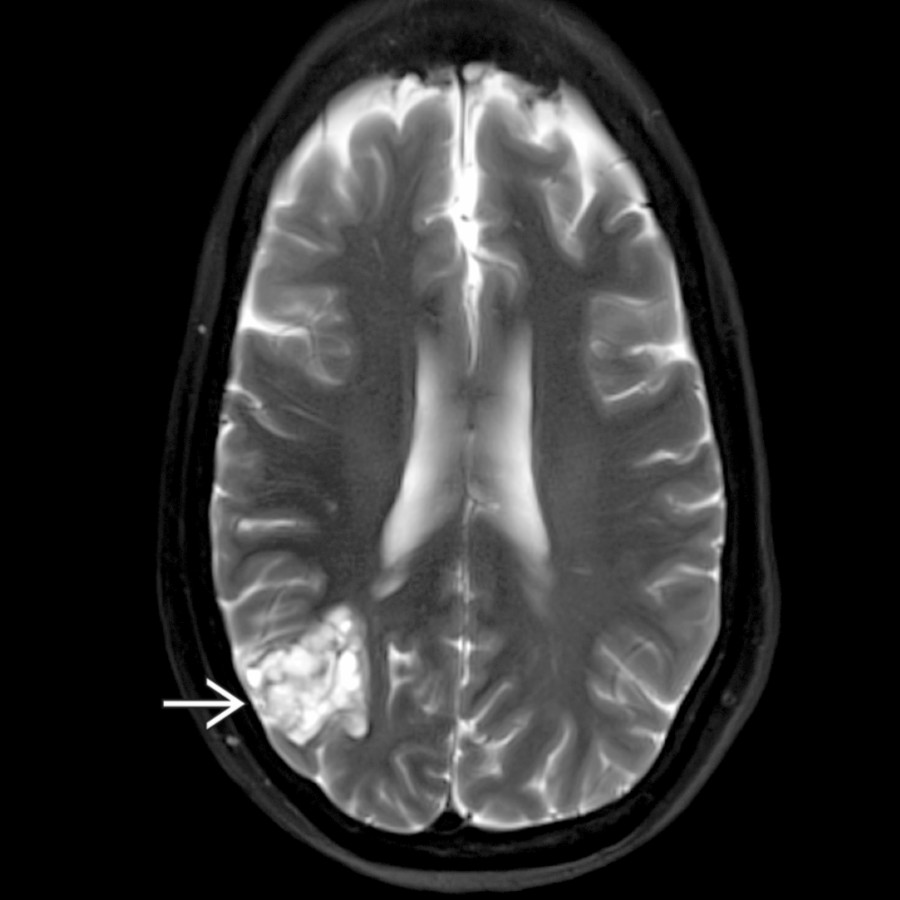 Axial T1 MR in a 61-year-old woman with intractable epilepsy and diagnosis of tuberous sclerosis at age 19 shows a right parietal lesion  with features suggesting DNET.
