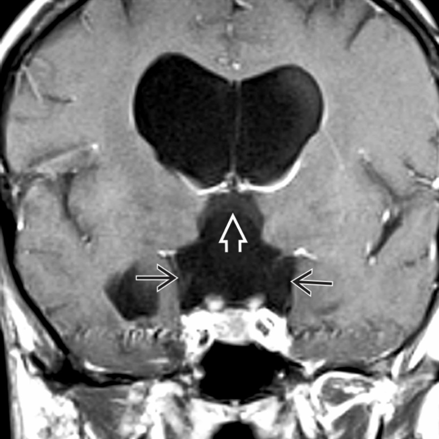 Coronal T1 C+ MR shows a large CSF-like cyst that elevates and compresses the 3rd ventricle  and causes obstructive hydrocephalus. Note straight cyst margins .