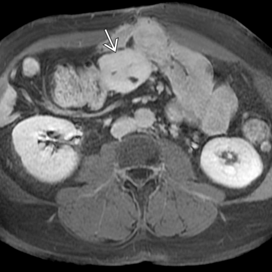 Axial T1 C+ MR in the same patient demonstrates that the mass  demonstrates homogeneous enhancement,  which increases on this delayed phase image. Because of their fibrotic component, desmoids can demonstrate relative T2 hypointensity and increasing delayed enhancement, as in this case.