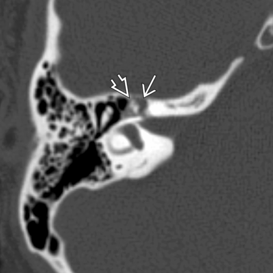 Axial bone CT in a patient with right facial nerve palsy shows a small FNVM in the geniculate fossa . Notice the punctate ossific foci  within the lesion. This finding allows differentiation of FNVM from facial nerve schwannoma, which also occurs most frequently in the geniculate fossa.
