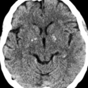 Axial NECT shows typical basal ganglia (BG) Ca⁺⁺ in this 75-year-old man who presented after minor trauma. Note the location within the globus pallidus (GP) , typical for normal aging brain. Physiologic Ca⁺⁺ is typically seen in adults over 30 years.
