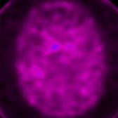 Axial I-123 ioflupane SPECT shows absent bilateral putamen activity and almost absent caudate activity. These findings are consistent with PD or APS if patient was not on any interfering medications.