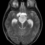 Axial T2 MR shows a T2-hyperintense mass  centered in the hypothalamus and optic chiasm with associated cysts . This was a pilocytic astrocytoma at resection. Low-grade astrocytomas typically have T2-hyperintense solid components.