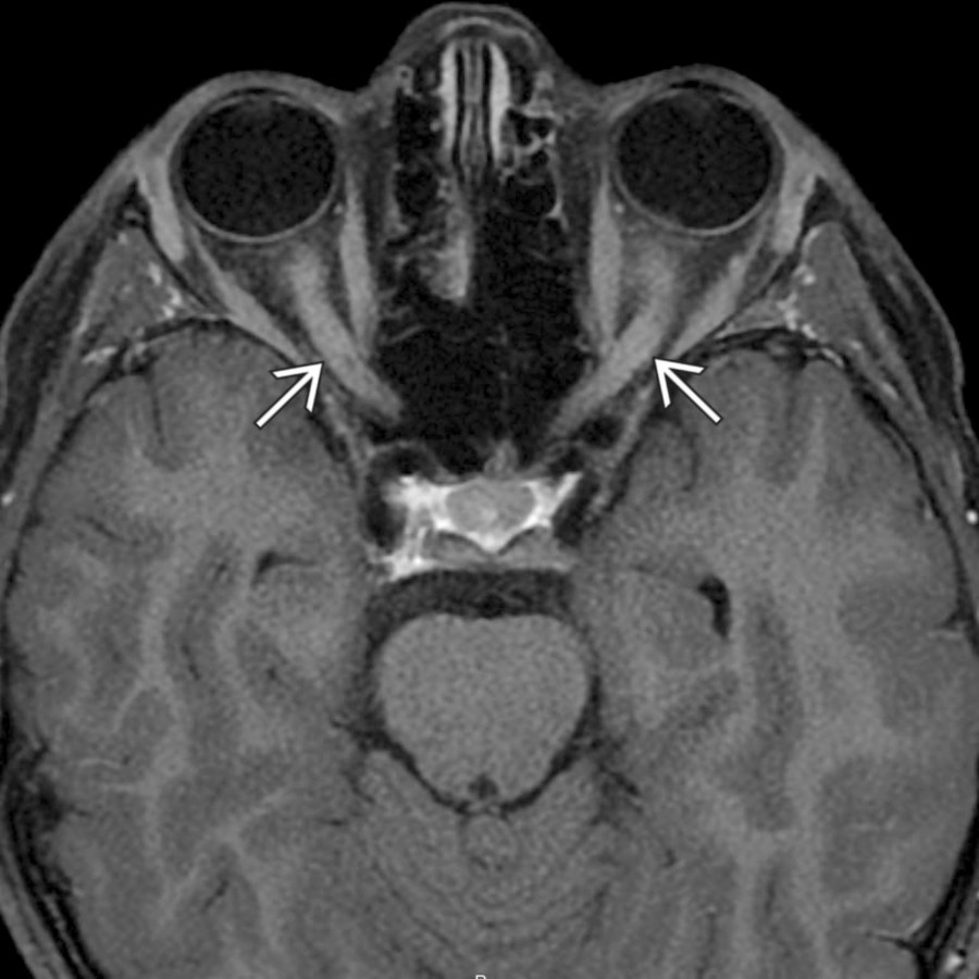 Axial T1 C+ FS MR through the orbits shows diffuse bilateral optic nerve enhancement  in this 9-year-old with vision loss. Clinical features were suggestive of NMOSD, but CSF analysis confirmed anti-myelin oligodendrocyte glycoprotein (MOG) disease.