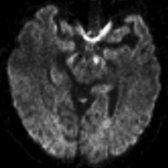 Axial DTI trace shows increased signal in the central cerebral peduncle  related to CST WaD. The lateral cerebral peduncle may show corticopontine tract involvement.