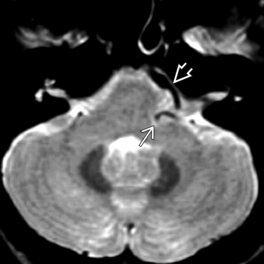 Axial T2 MR shows a markedly asymmetric left vertebral artery  lifting the posterior inferior cerebellar artery  into the medial aspect of the CPA cistern in the CNVII root exit zone vicinity.